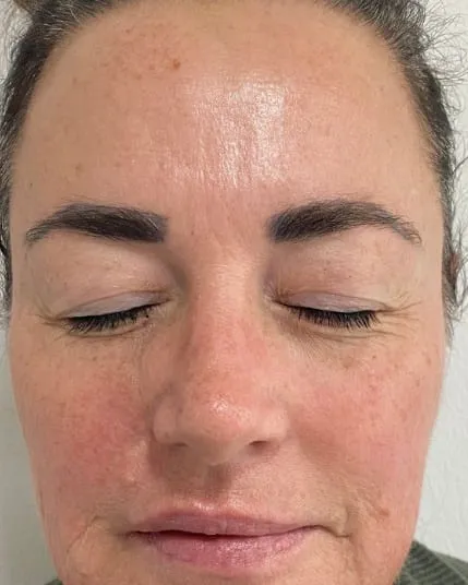 The same front view after a Fotona 4D facelift, with the redness settled and the texture finer