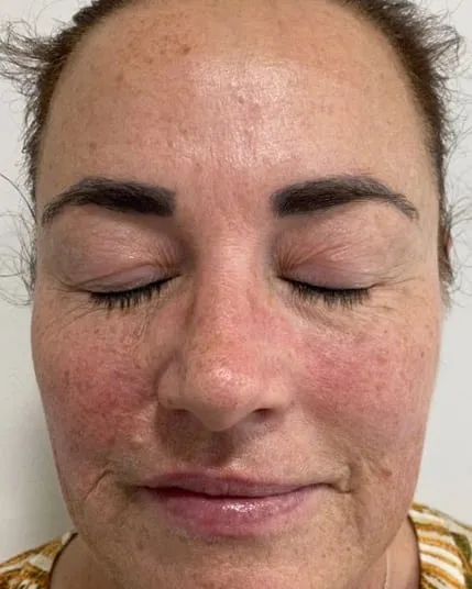Front view of a woman’s face before a Fotona 4D facelift, showing redness and coarse texture across the cheeks and nose