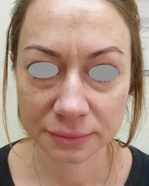 Front view of a woman’s face before a Fotona 4D facelift, showing puffiness and shadowing under the eyes over dull tone