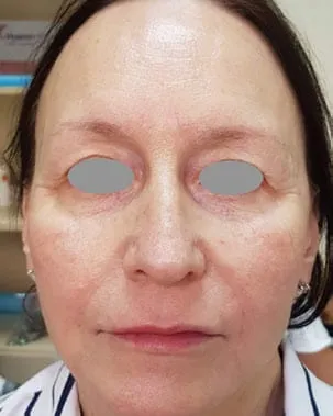 The same front view after a Fotona 4D facelift, with the folds softer and the lines around the mouth shallower