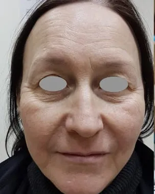 Front view of an older woman’s face before a Fotona 4D facelift, showing deep nasolabial folds and lines around the mouth