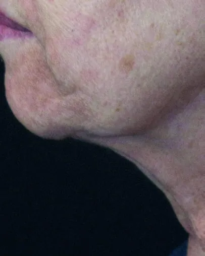 The same profile after a Fotona 4D facelift, with the skin under the jaw firmer and the line cleaner