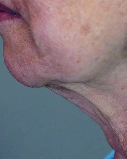 Close profile of a woman’s chin and neck before a Fotona 4D facelift, showing slack skin and crepey texture under the jaw