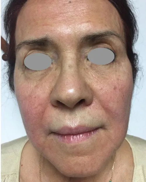The same front view after a Fotona 4D facelift, with the patches lighter and the folds softer