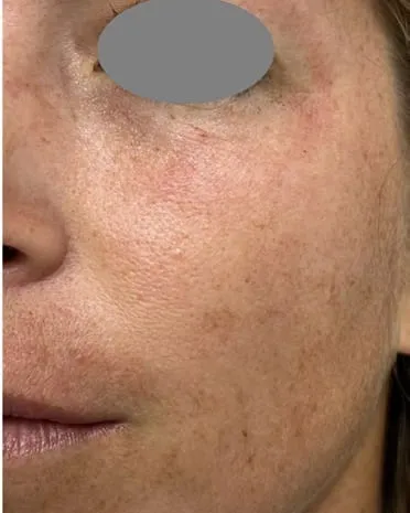 The same cheek after a Fotona 4D facelift, with the colour more even and the texture finer