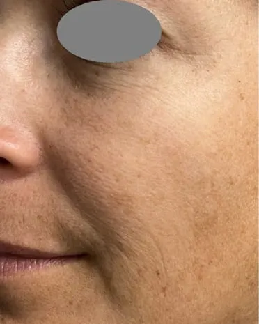 Close three-quarter view of a woman’s cheek before a Fotona 4D facelift, showing mottled pigment over coarse texture