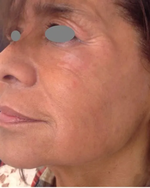 The same cheek after a Fotona 4D facelift, with the fold softer and the fanning lines shallower