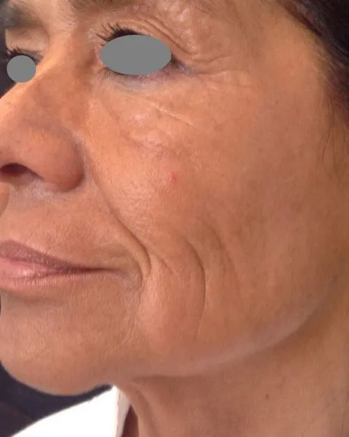 Three-quarter view of a woman’s cheek before a Fotona 4D facelift, showing a deep nasolabial fold with fine lines fanning across the cheek