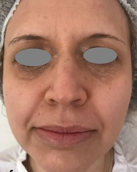 Front view of a woman’s face before a Fotona 4D facelift, showing sallow, uneven tone with shadowing under the eyes