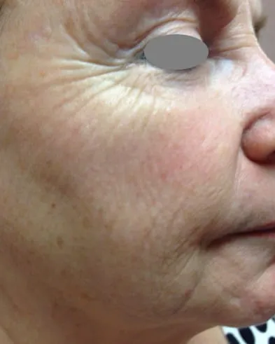 Close three-quarter view of a woman’s cheek before a Fotona 4D facelift, showing crosshatched crepey lines and scattered pigment spots