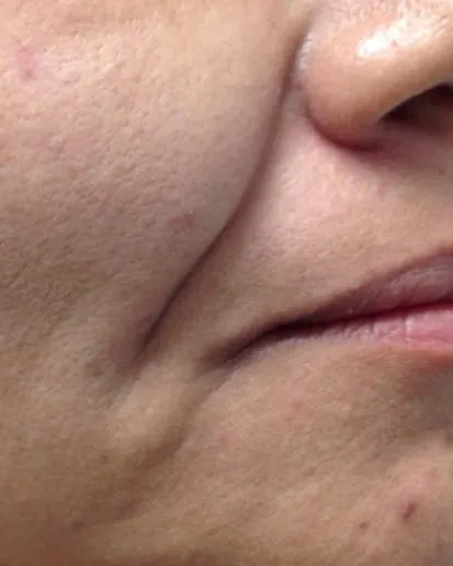 Close view of the corner of a woman’s mouth before a Fotona 4D facelift, showing a line running down from the mouth and slackness along the jaw