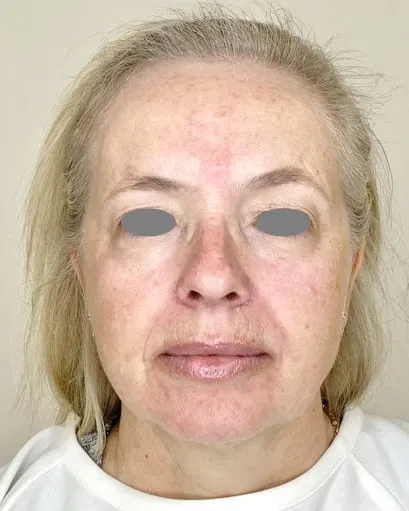 Front view of a woman’s face before a Fotona 4D facelift, showing nasolabial folds, a softening jaw line and dull tone