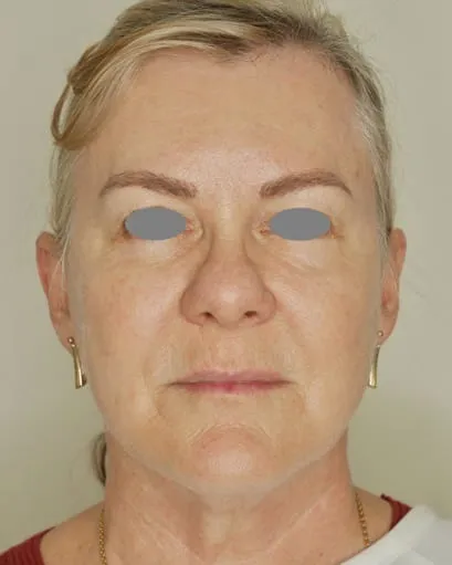 The same front view after a Fotona 4D facelift, with the tone more even and the jaw line firmer