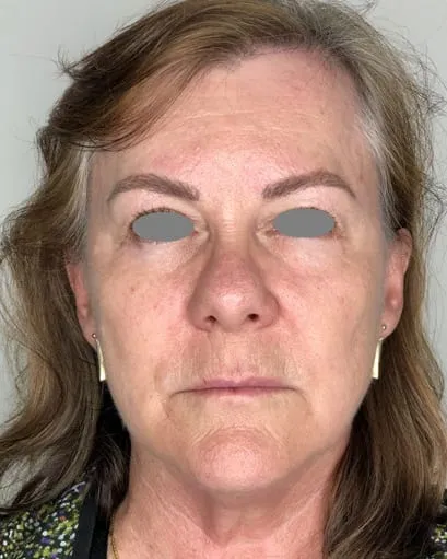 Front view of a woman’s face before a Fotona 4D facelift, showing reddened, uneven tone with nasolabial folds and a slack jaw line