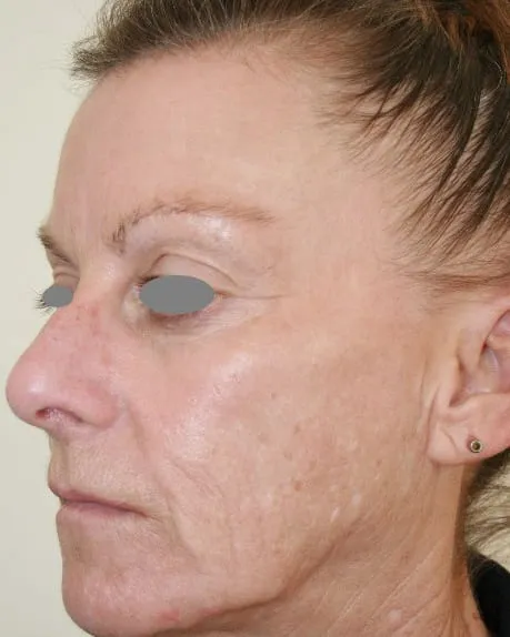 The same cheek after a Fotona 4D facelift, with the lines shallower and the skin firmer