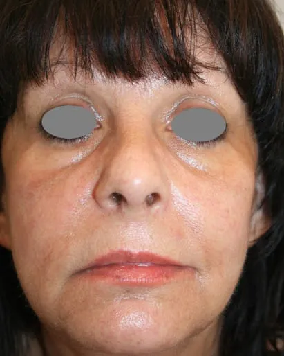 The same front view after a Fotona 4D facelift, with the tone brighter and the cheek firmer