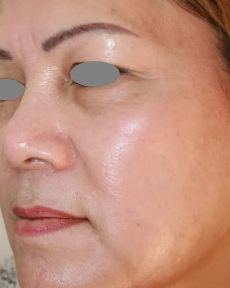The same cheek after a Fotona 4D facelift, with the pigment much lighter and the tone even