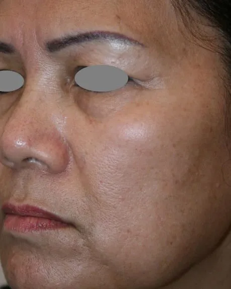 Three-quarter view of a woman’s cheek before a Fotona 4D facelift, showing mottled brown pigment over dull tone