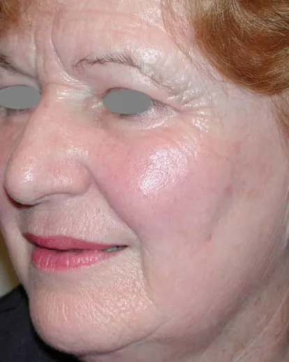 The same three-quarter view after a Fotona 4D facelift, with the lines smoother and the skin brighter