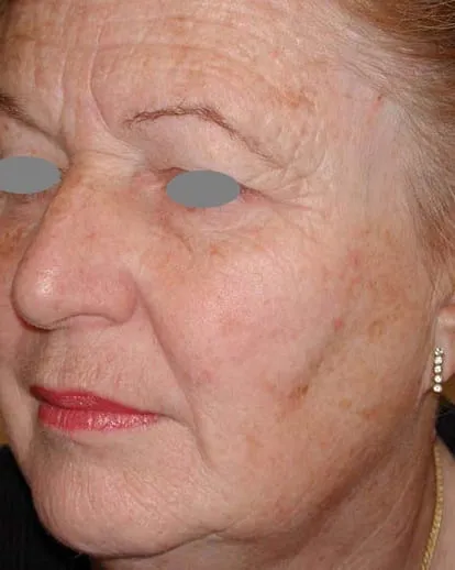 Three-quarter view of an older woman’s face before a Fotona 4D facelift, showing deep crepey lines across the cheek and around the mouth
