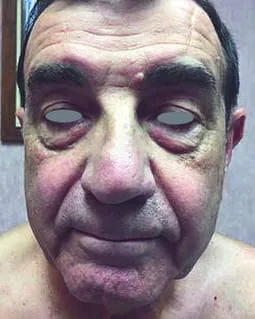 Front view of a man’s face before a Fotona 4D facelift, showing ruddy, mottled colour over coarse texture
