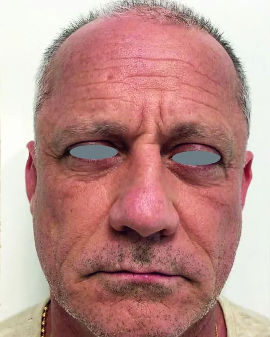 Front view of a man’s face before a Fotona 4D facelift, showing reddened skin with deep forehead lines and coarse texture