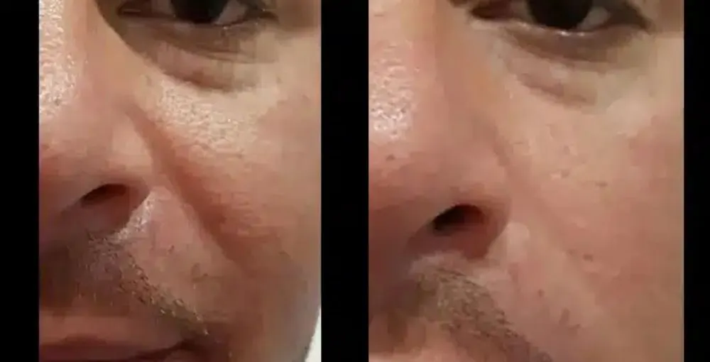 Fotona 4D Facelift before and after: the same person before treatment on the left and after treatment on the right, case 1. Results may vary.