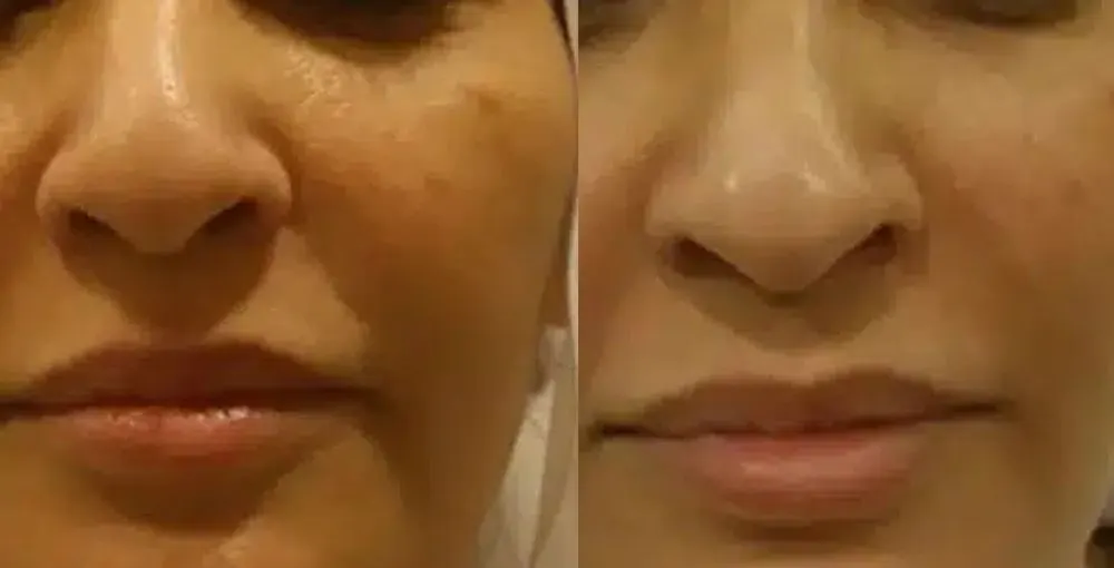 Fotona 4D Facelift before and after: the same person before treatment on the left and after treatment on the right, case 3. Results may vary.