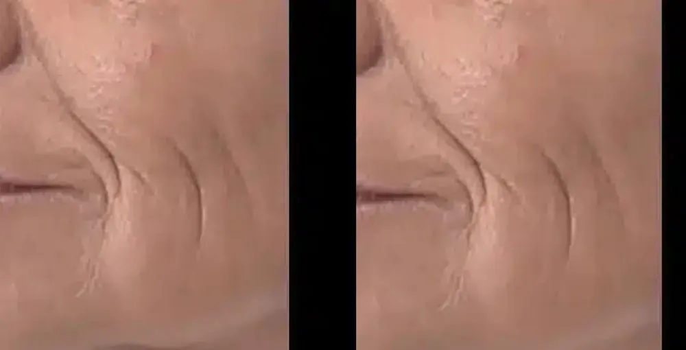 Fotona 4D Facelift before and after: the same person before treatment on the left and after treatment on the right, case 4. Results may vary.