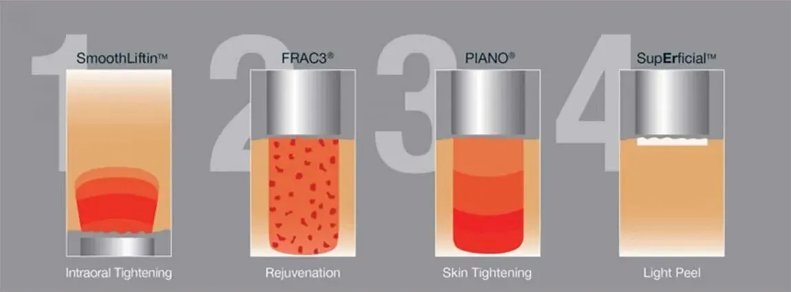 Fotona's four-step depth diagram, showing how far into the skin each of the four Fotona 4D passes reaches, from behind the lip through to the skin surface