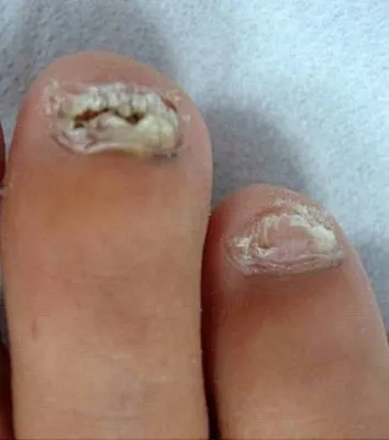 Close-up of two toenails before laser fungal nail treatment, thickened and white-yellow with crumbling tips
