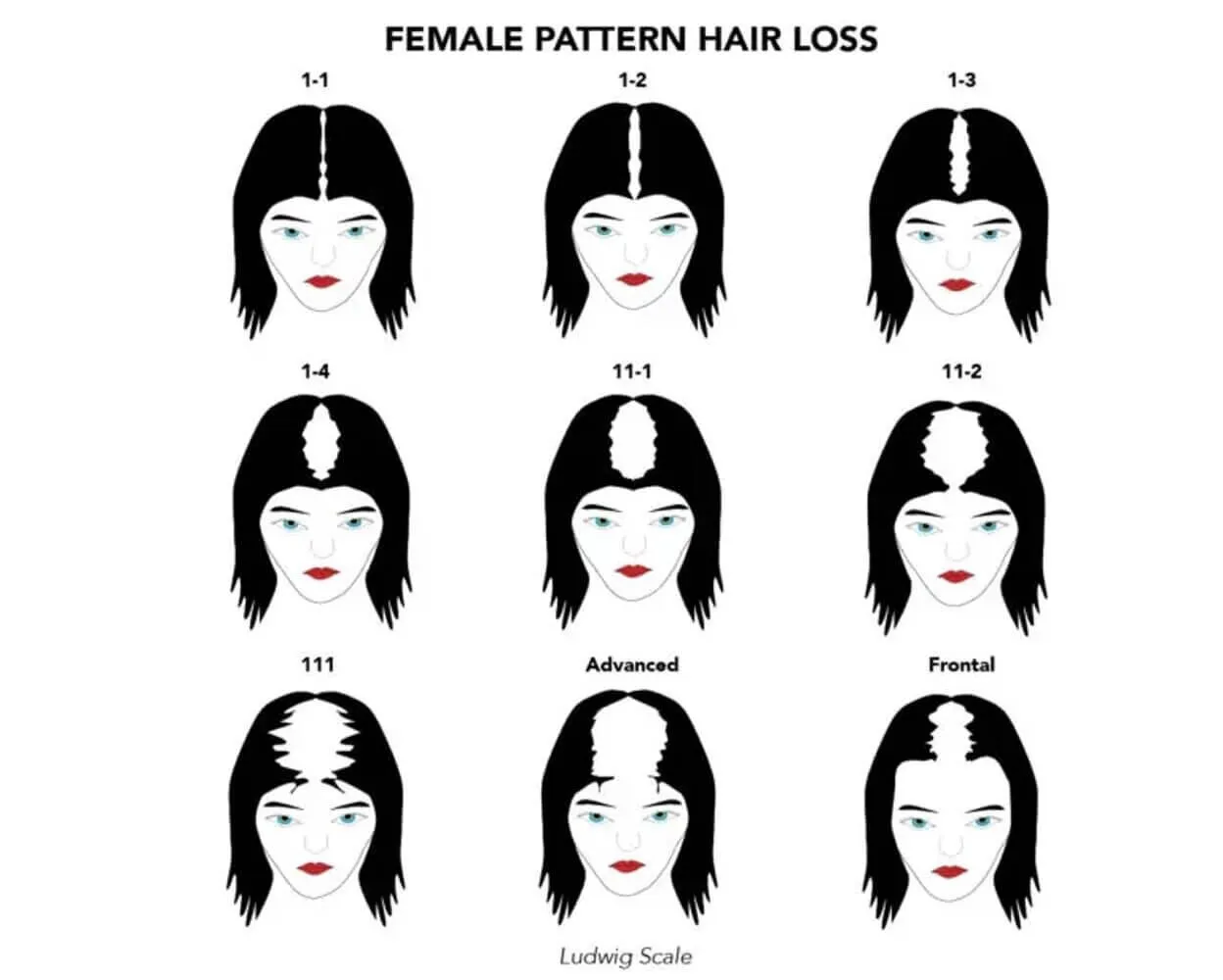 The Ludwig scale of female pattern hair loss, illustrated as nine stages showing a part line widening progressively across the crown