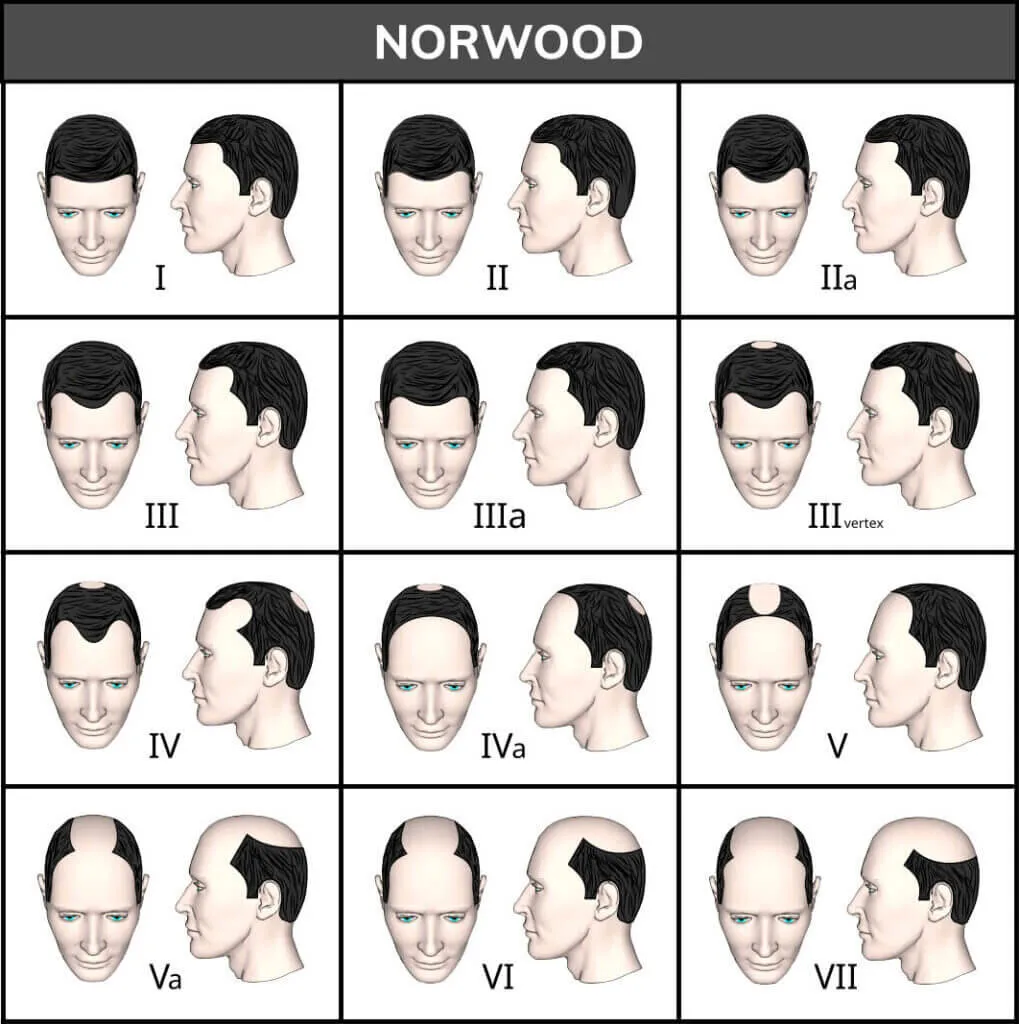 The Norwood-Hamilton scale of male pattern hair loss, illustrated as twelve stages from I to VII showing progressive temple recession and crown thinning in front and profile view