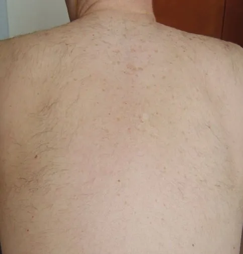 The same upper back and shoulders after laser hair removal, with only fine sparse hair left