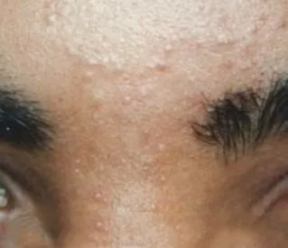 The same close-up after laser hair removal, with the gap between the brows clear