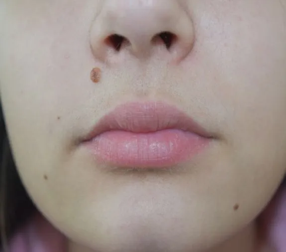 The same upper lip and chin after laser hair removal, with the skin clear