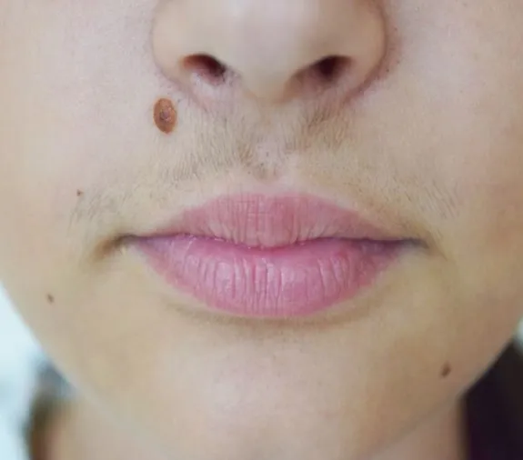 Upper lip and chin of a woman before laser hair removal, showing dark hair along the lip and chin