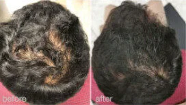 HaiRestart before and after, enlarged: the same person before treatment on the left and after treatment on the right, case 1. Results may vary.