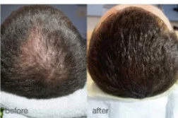 HaiRestart before and after, enlarged: the same person before treatment on the left and after treatment on the right, case 4. Results may vary.