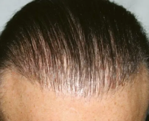 The same frontal hairline after a course of HaiRestart, carrying visibly more hair
