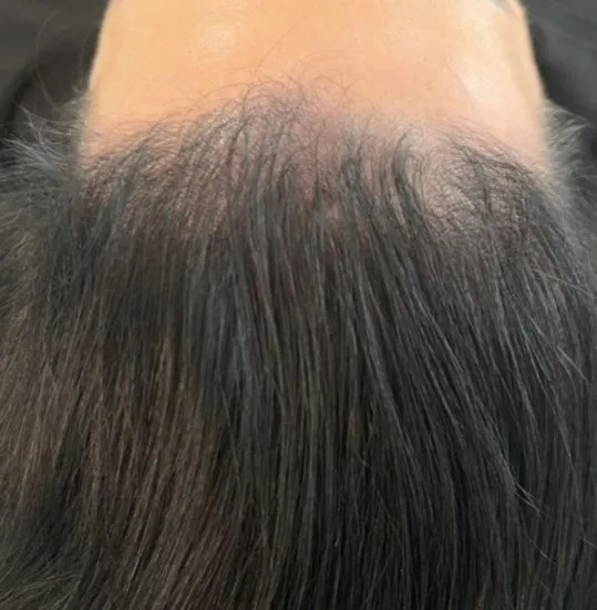 The same forehead and hairline after a course of HaiRestart, with the temples and front filled in
