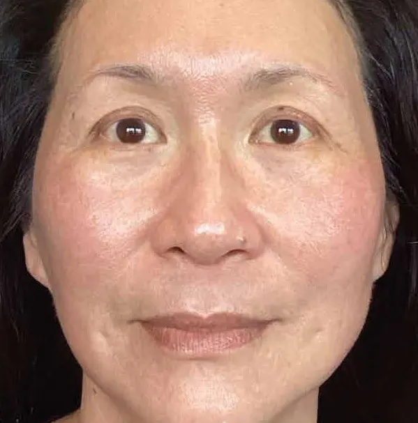 The same front view after treatment, with the patching and spotting cleared and the tone even across the face