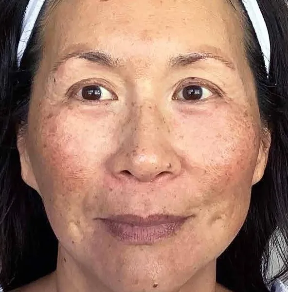 Front view of a woman before treatment, showing brown patching across both cheeks with dense small spots over the cheeks and nose