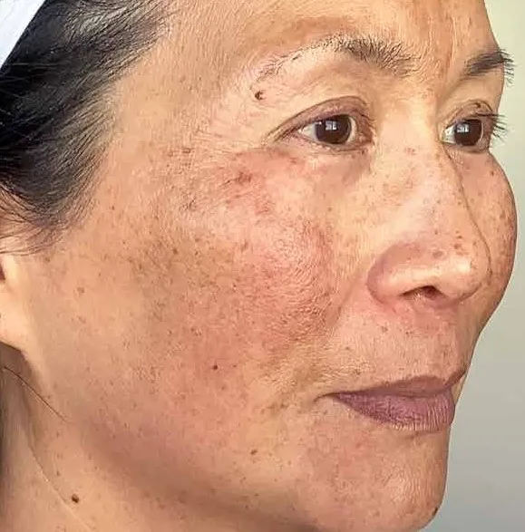 Three-quarter view of the same woman before treatment, showing a broad mottled patch from the temple down the cheek with spots layered over it