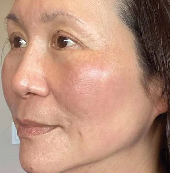 The same view after treatment, with the discrete spots lifted and a faint even warmth left across the cheek