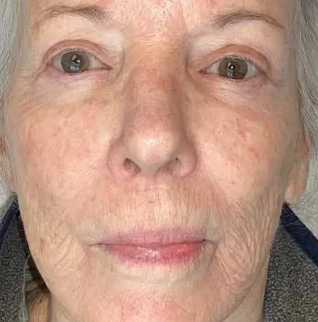 Front view of a second woman before treatment, showing small brown sun spots scattered across the cheeks, the nose and around the eyes