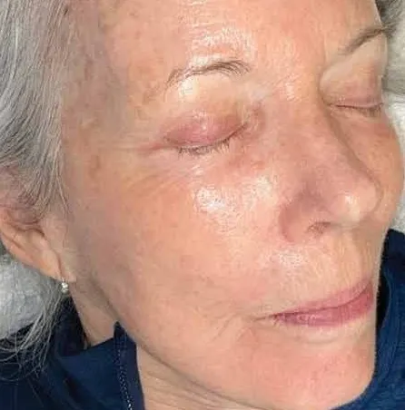 The same three-quarter view after treatment, with the cheek and temple spotting faded