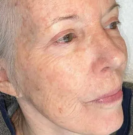 Three-quarter view of the same second woman before treatment, showing brown spots across the cheek and temple over finely crinkled skin