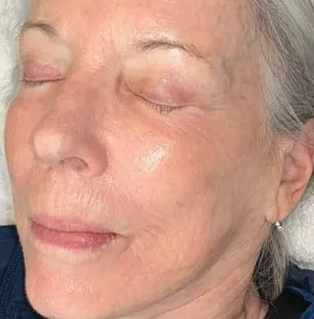 The same view after treatment, with most of the spotting gone and a patch of colour left on the mid-cheek