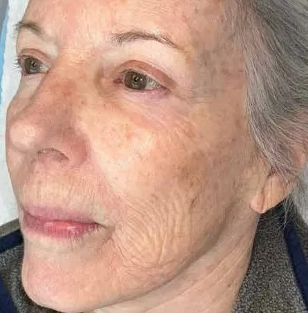 The other three-quarter view of the same second woman before treatment, showing brown spots massed across the cheek and along the jaw